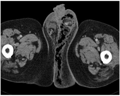 We did not find results for: Genitoscrotal Emergencies | Abdominal Key