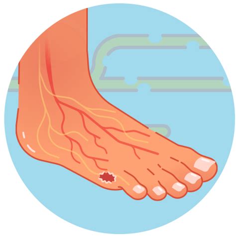 Prevent Diabetic Foot Ulcers And Avoid Amputation Home Care Delivered