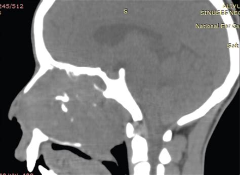 Computed Tomographic Findings Of Sinonasal Granulomatous Mucormycosis