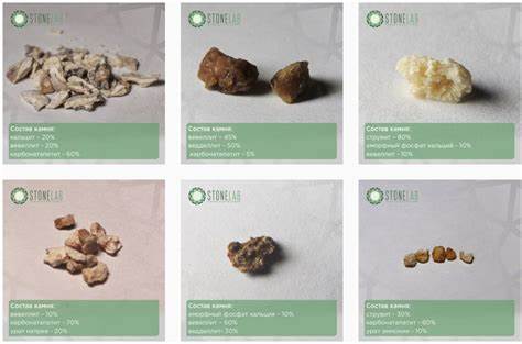 Виды почечных камней фото Виды почечных камней фото