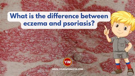 What Is The Difference Between Eczema And Psoriasis Your Info Master
