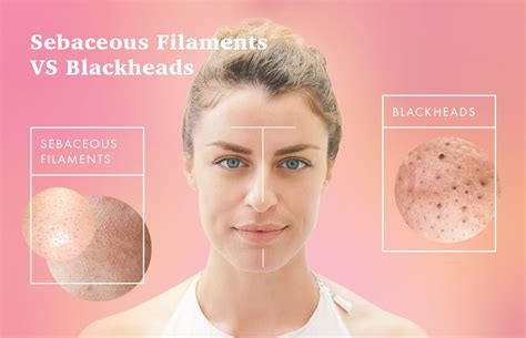 Blackheads On Your Nose And Chin They May Be Sebaceous Filaments
