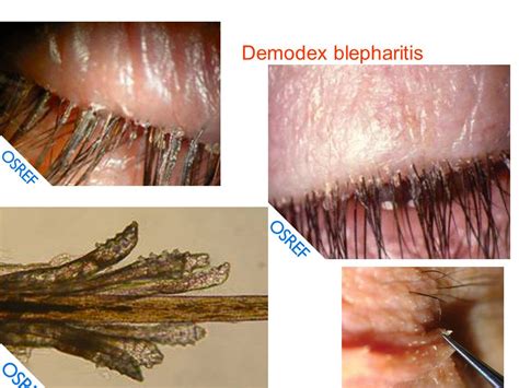 25 Images Demodex Scalp Symptoms Demodectic Mange