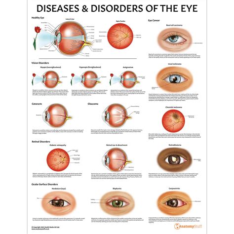 Diseases And Disorders Of The Eye Chartposter Laminated