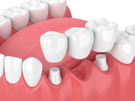 Qu Es Un Puente Dental Tipos Y Caracter Sticas Clinica Dental Oris