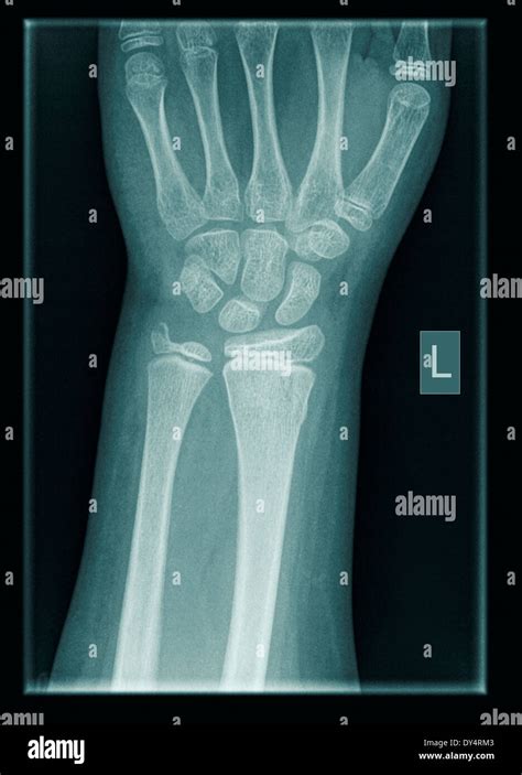 X Ray Of Wrist Of 9 Year Old Male Patient With Distal Radius And Ulna