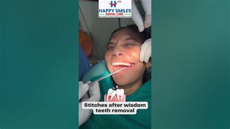 Stitches After Wisdom Teeth Removal Happy Smiles Dental Care