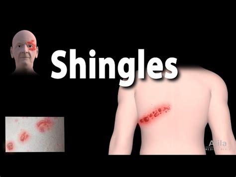 Shingles Blog On Shingles