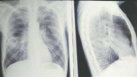 Chest X Ray With Lung Abscess Download Scientific Diagram