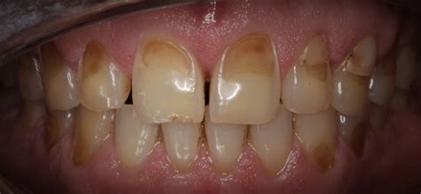What Is Tooth Erosion And Is It Dangerous Acharya Dental
