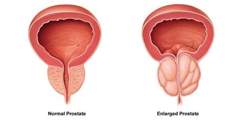 Transurethral Resection Of Prostate Turp Chin Chong Min Urology
