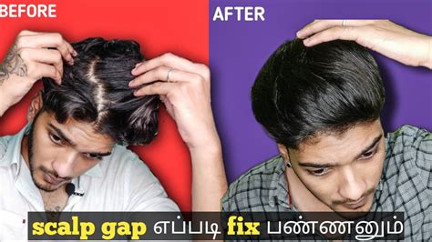 How To Fix Male Patterned Baldness 100 Working Ar Stuffz Youtube