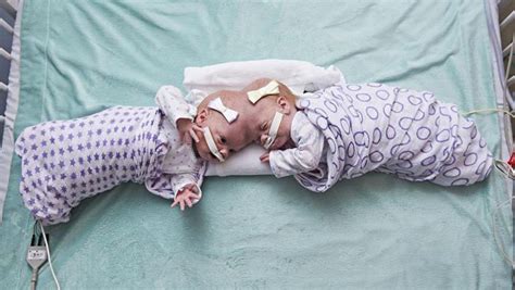 3d Printing Helps Separate Rare Case Of Conjoined Twins
