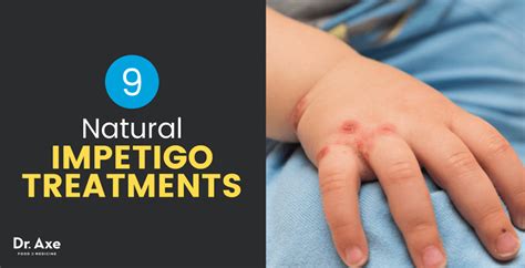 Impetigo Causes Symptoms Plus 9 Natural Treatments Dr Axe
