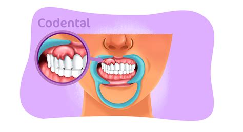 Abscesso Na Gengiva Causas Sintomas E Tratamento