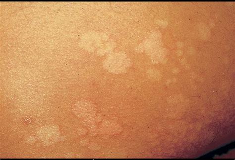 Pityriasis versicolor is a common yeast infection of the skin, in which flaky discoloured patches appear on the chest and back. Pityriasis versicolor - Toaler