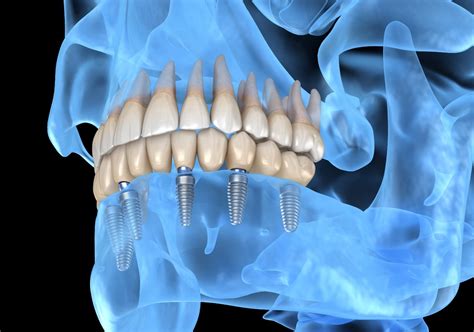 Can You Get Dental Implants After Having Dentures For Years