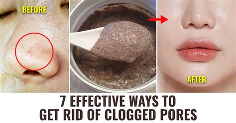 Get Rid Of Clogged Pores With These Effective Tips Removemania