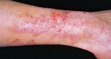 Celiac Disease Skin Rashes