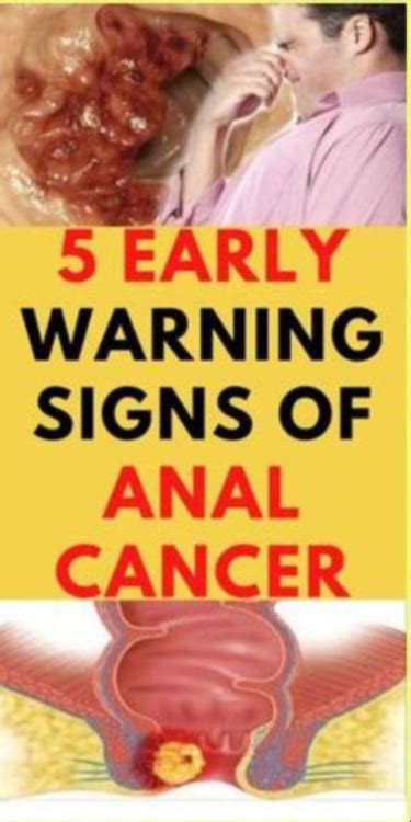 5 Early Warning Signs Of Anal Cancer Artofit