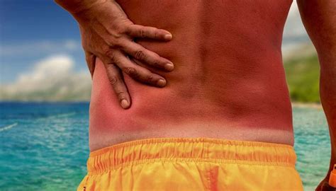Hells Itch How To Treat A Severe Sunburn Itch