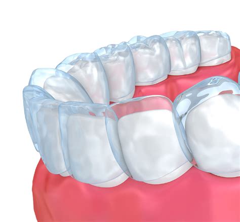 Invisalign® Victoria Tx Zboril Dental Center Clear Braces