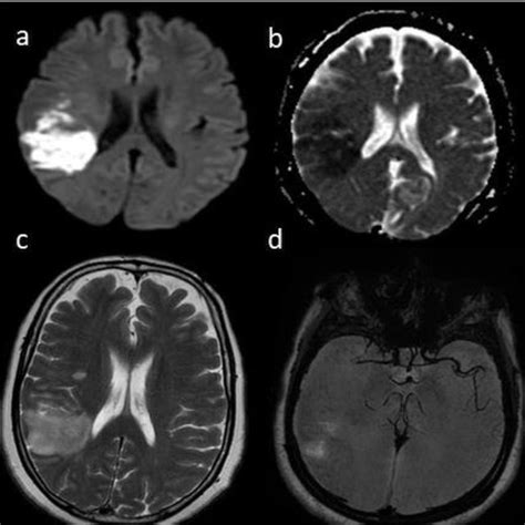 Mri Perfusion Diffusion Mismatch The Small Lesion On Download
