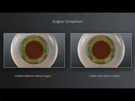 Laser Cataract Surgery With Catalys Animation Youtube