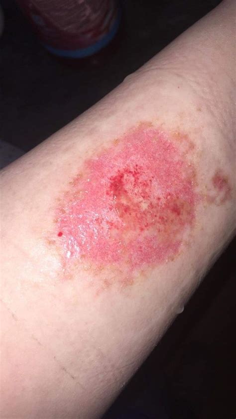 Mums Arm Rots Away After Oven Cleaner Causes Horror Burns On Mother