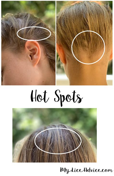 Hair dye brands that kill lice. Dead vs Live Nits: Color of Lice Eggs - My Lice Advice