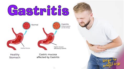 Gastritis Causes Signs And Symptoms Foods To Avoid Gastritis Youtube