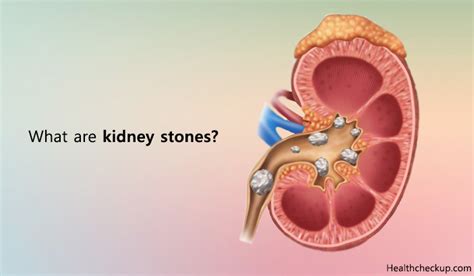 Types Of Kidney Stones And Treatment Signs And Symptoms Of Kidney Stones