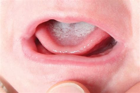 White Patchy Tongue You May Be Suffering From Oral Thrush Nation