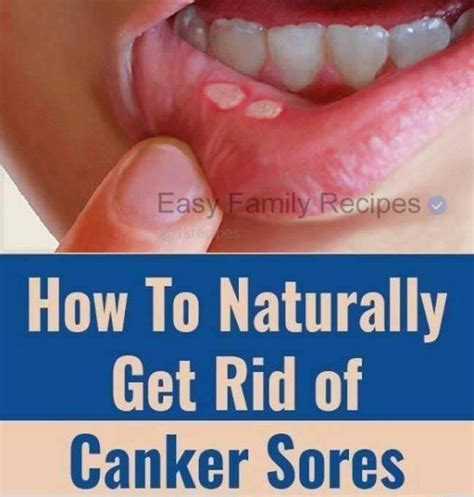 Canker Sores In Mouth Here Is How To Natural Get Rid Of Them In A