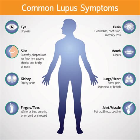 Peripheral Neuropathies Lupus Butterfly Rash Pain Resource