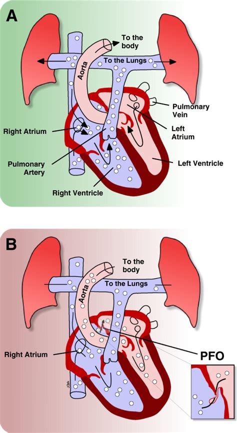 Paradoxical Gas Embolism Schematic Drawing Demonstrating The