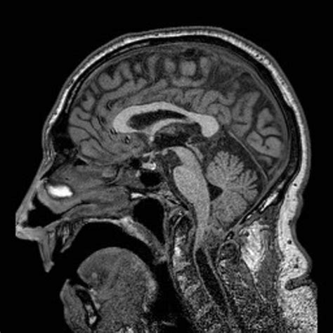 Subependymoma Sagittal Non Enhanced T1 Weighted Image Shows A