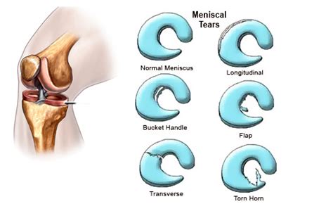 Meniscus Tear In Knee Signs Symptoms Surgery And Rehab Sportsmd