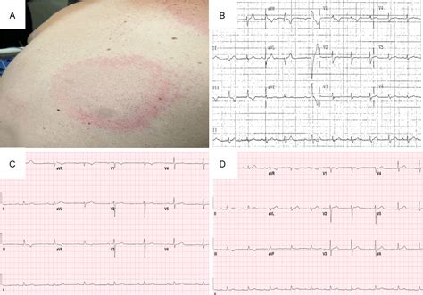 Figure 1 From Early Onset Lyme Carditis With Concurrent Disseminated