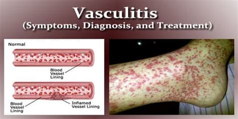 Vasculitis Symptoms Diagnosis And Treatment Assignment Point