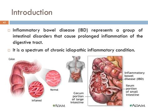 Inflammatory Bowel Disease