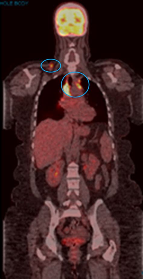 Fdg Pet Ct Scan The Value Of 18 F‑fdg Petct In The Prediction Of