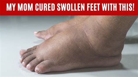Home Remedies For Swollen Feet Edema Remedy Youtube