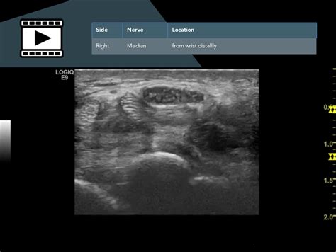 Carpal Tunnel Syndrome Nerve Ultrasound Course Sonocampus