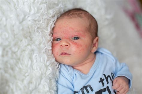 Baby Acne On Face What Are The Causes And Treatments — My Babys