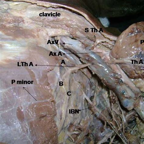 Photograph Of Dissected Area Axv Axillary Vein Axa Axillary Artery