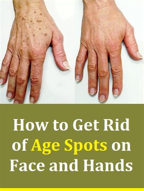 How To Get Rid Of Age Spots On Face And Hands Age Spots On Face