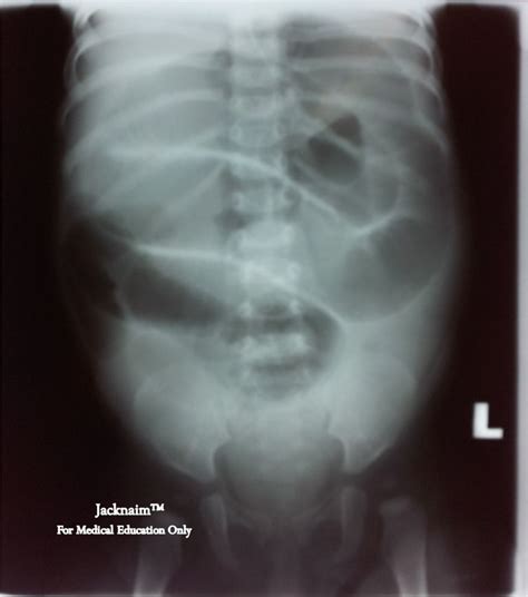 My Medical Notes Abdominal X Ray Intussusception
