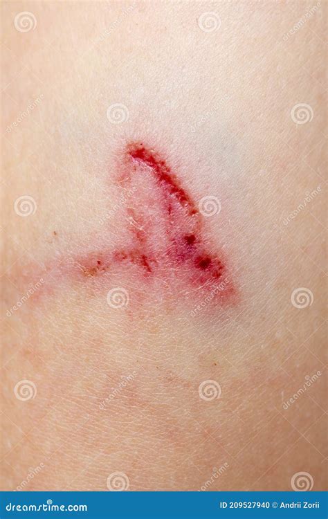 A Wound On The Human Body Deep Cut Scar Closeup Deep Scratches On