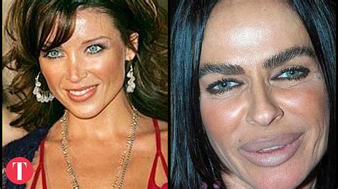 The Most Extreme Cases Of Celebrity Plastic Surgery Celebrity Plastic